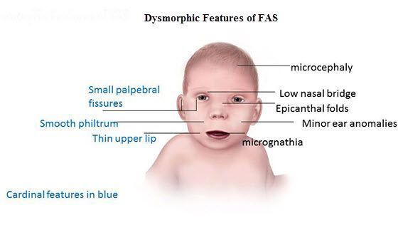 best of Effects syndrome of Facial down