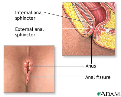 Bandicoot reccomend Do anal fissures require surgery