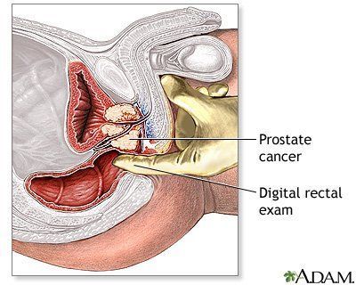 Prostatic fluid no orgasm