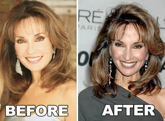 Susan lucci boob job