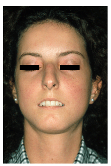 best of Pictures Facial scleroderma