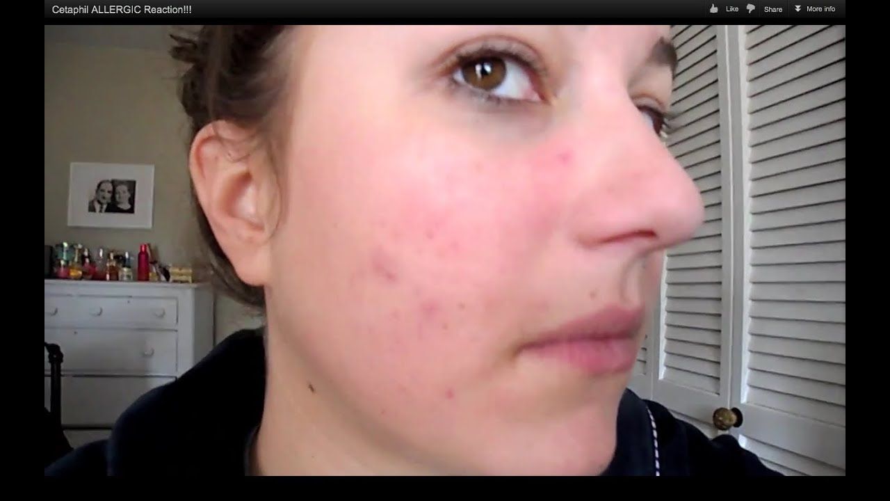 best of Reation Facial allergic