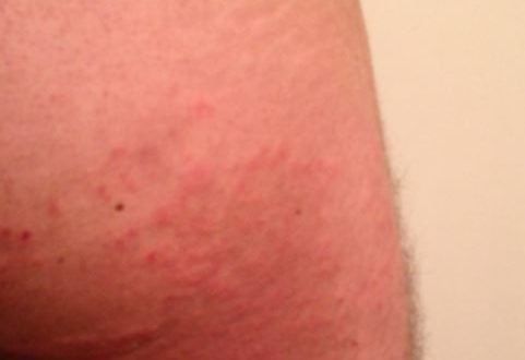 Adult male butt rash