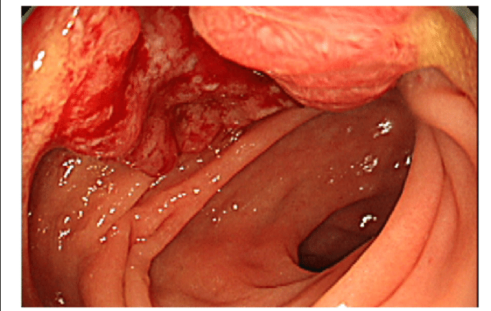 Anal rectal carcinoma