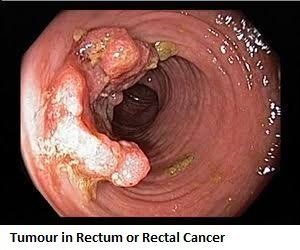 best of Carcinoma Anal rectal