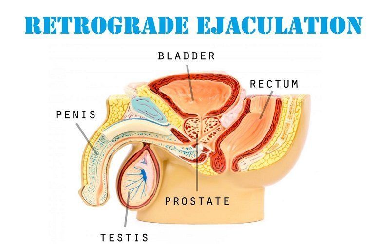 Absent ejaculation orgasm