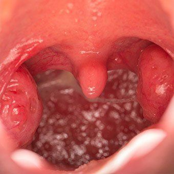 best of Sex sore throat After oral