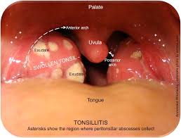 Streph throat in adults