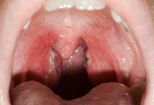 After oral sex sore throat