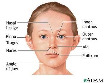 Doctor reccomend Facial effects down of syndrome