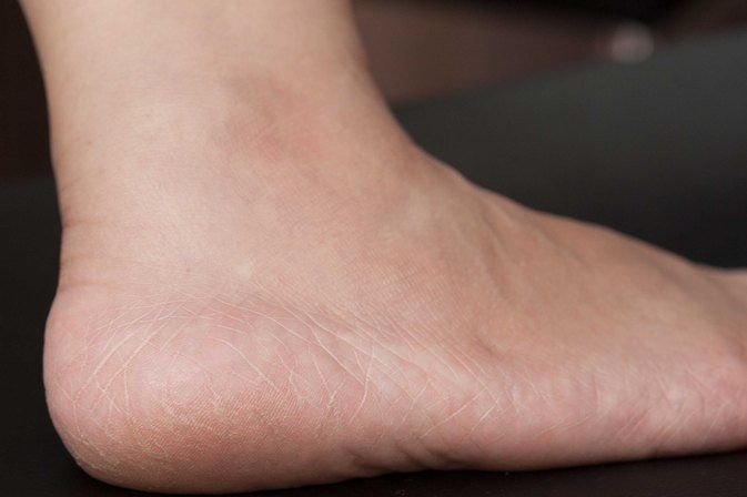 Bottom of foot dry skin