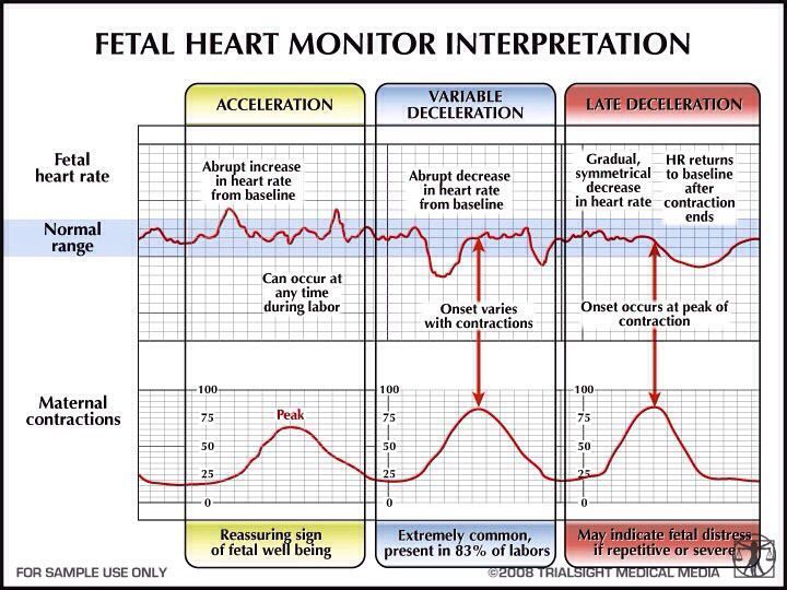 Icecap reccomend Fetal rhythm strip