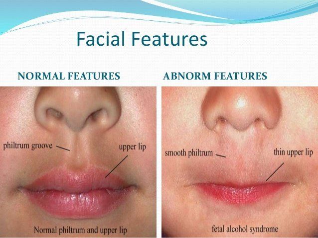 Big L. reccomend Fetal alchol syndrome facial