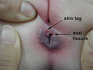 Firefly reccomend Professional anal rectal tag surgical removal