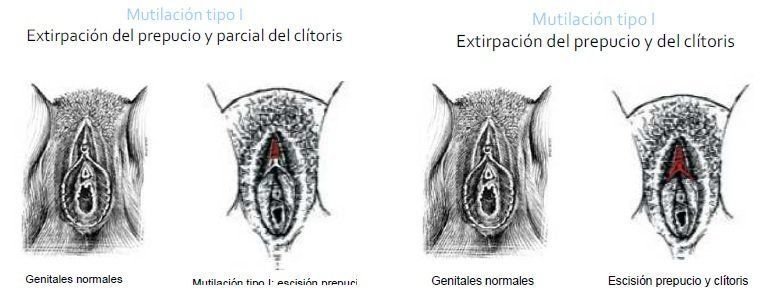 Ablacion del clitoris