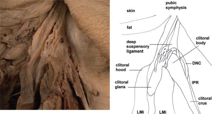 Abnormal clitoris glans