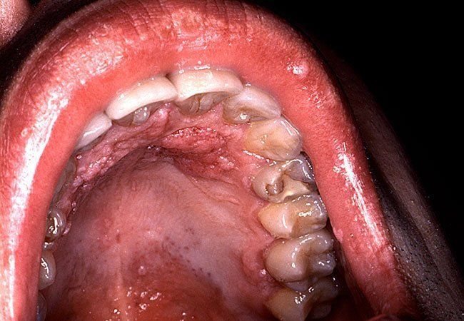 best of Sex sore throat After oral