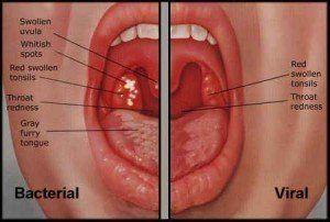 Snapdragon recomended Causes for anal strep infection