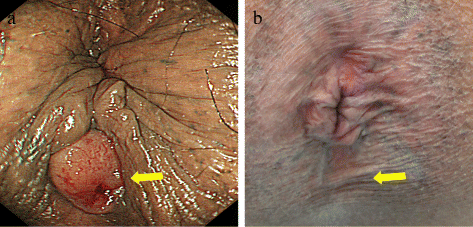 best of Carcinoma Anal rectal