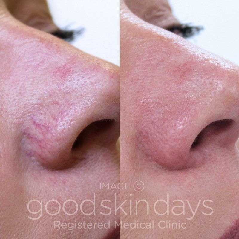 Reno reccomend Removal of facial thread veins