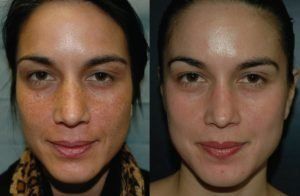 Facial peel vancouver