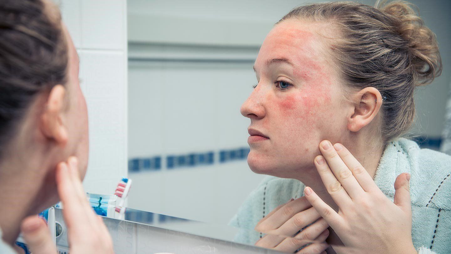 Facial skin eruptions