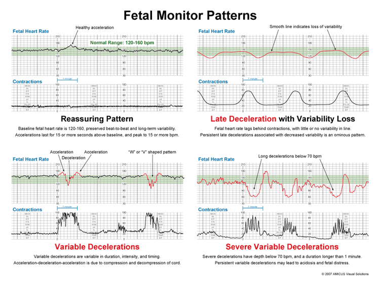 best of Strip Fetal rhythm