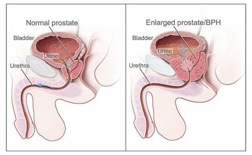 Prostatic fluid no orgasm