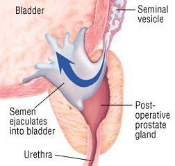 Prostatic fluid no orgasm